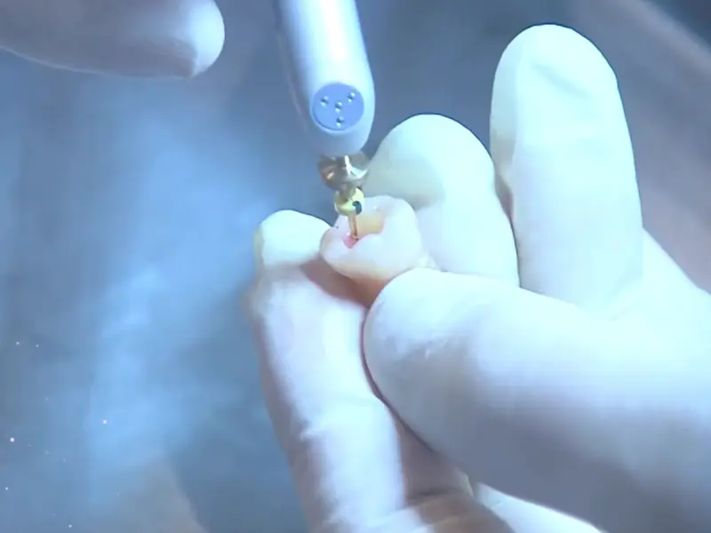 Aplicação de laser odontológico em close